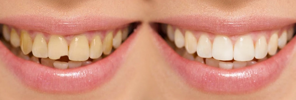 teeth bonding results picture