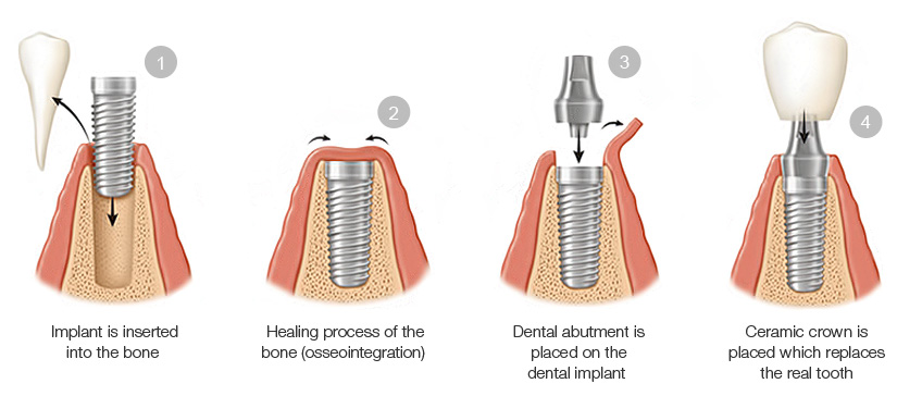 this is a picture of dental implant process