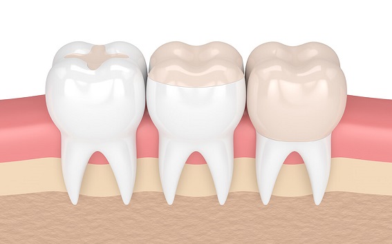 this is an image of dental inlay onlays and crowns