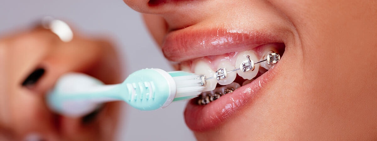 this is an image of a woman brushing over braces