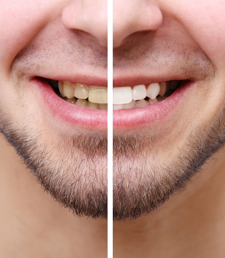 before and after tooth whitening
