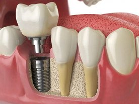 this is an image of dental implant