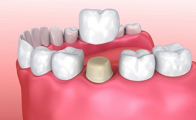 image of a dental crown