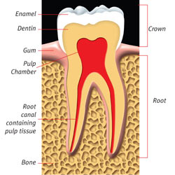 this is an image of root canal treatment