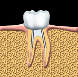this is an image of root canal treatment