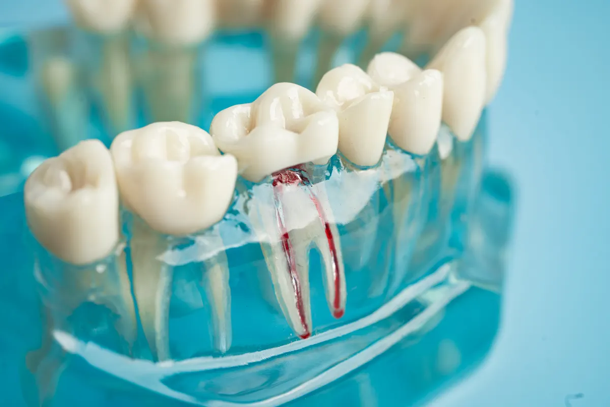 7 Signs You Need A Root Canal