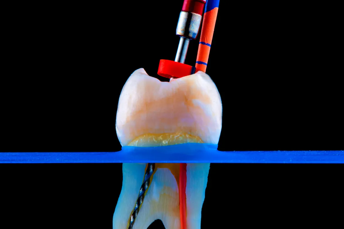 Understanding The Root Canal Procedure